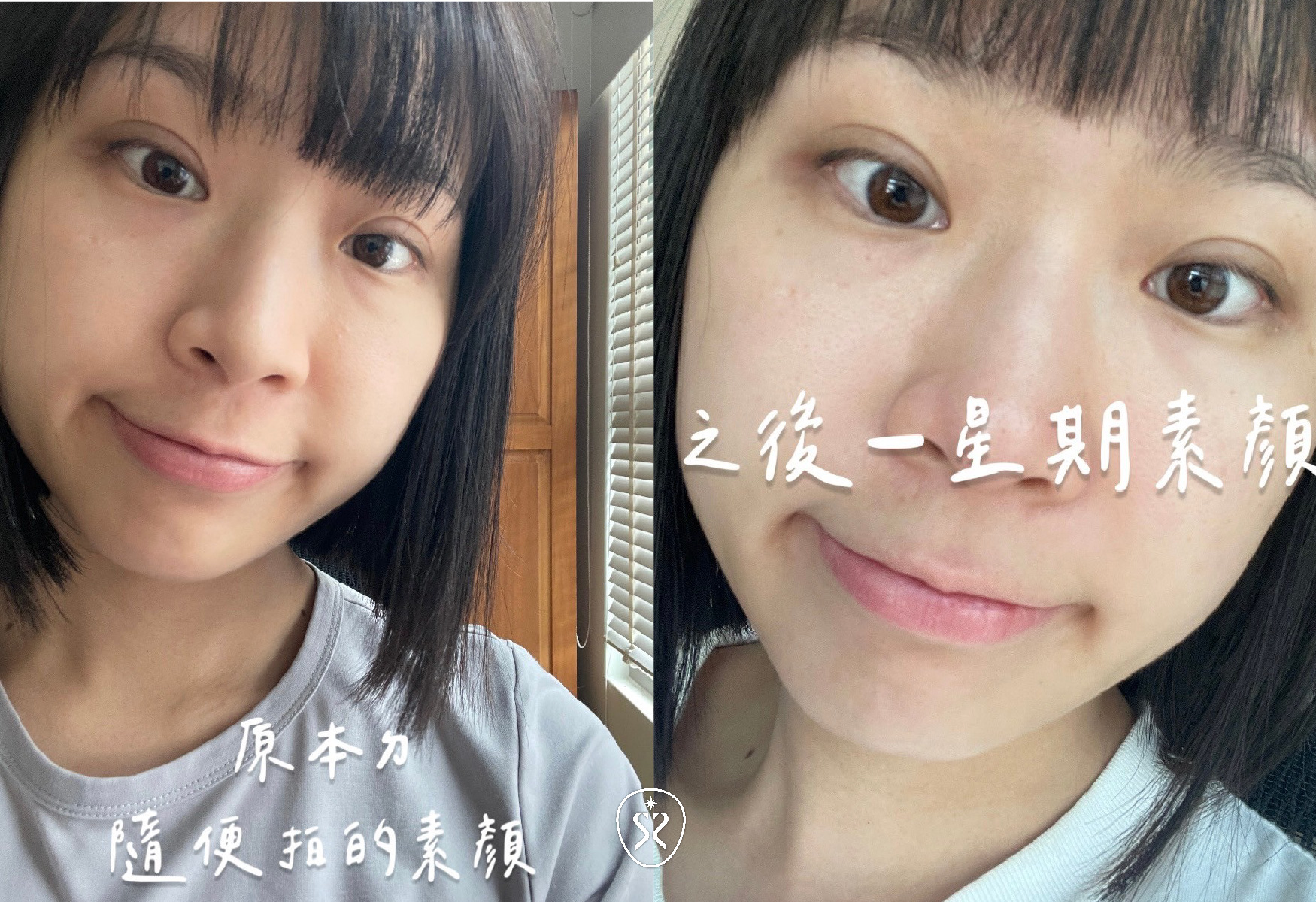 自強星和診所竹北-薇貝拉軟組織植入劑淚溝填補